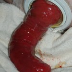 Jake (Wil's stoma) has major prolapse Jake (Wil's stoma) has major prolapse
